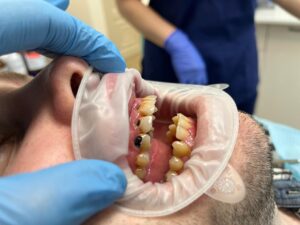 Лечение пришеечного кариеса фронтальной зоны зубов, реставрация
